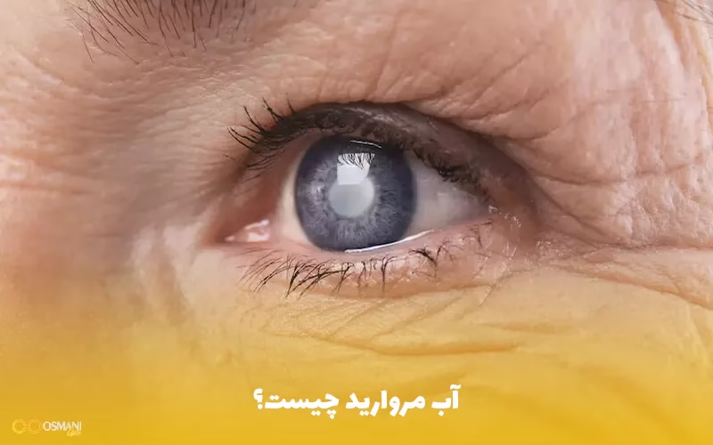 یکی از بیماری های شایع چشمی آب مروارید است که با بالا رفتن سن بیشتر می شود. کسانی که به این بیماری مبتلا هستند احساس میکنند که نواحی ابری بر روی عدسی چشم هایشان به وجو