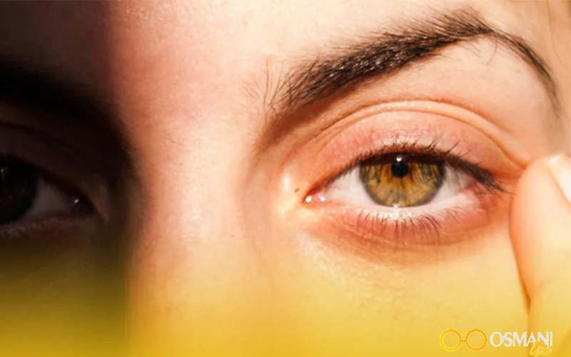 اشعه مضر آفتاب برای چشم