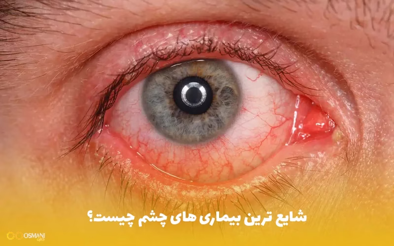 شایع ترین بیماری های چشم چیست؟