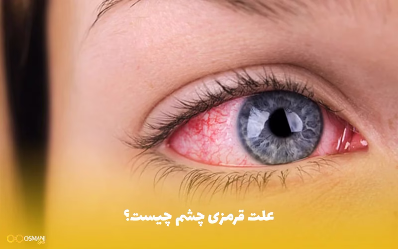 علت قرمزی چشم چیست؟